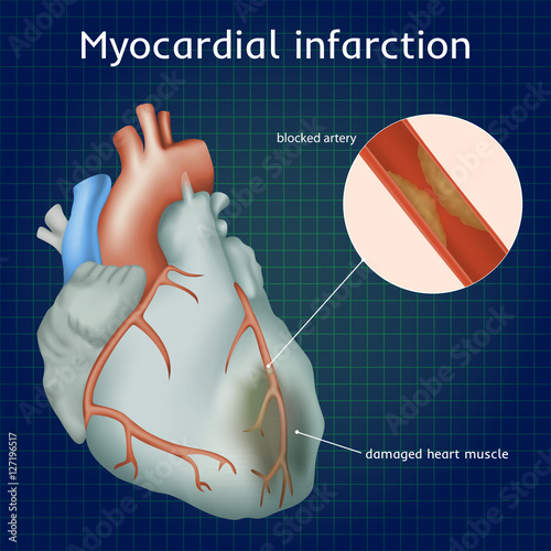 Myocardial infarction. Heart attack. Blocked artery, damaged heart muscle. Anatomy illustration. Colorful image, dark blue science background.