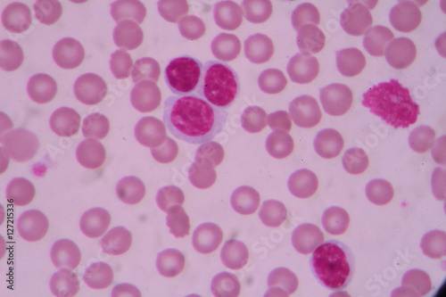 Blood smear shows large number of cancer leukemia cells(Blast cells)