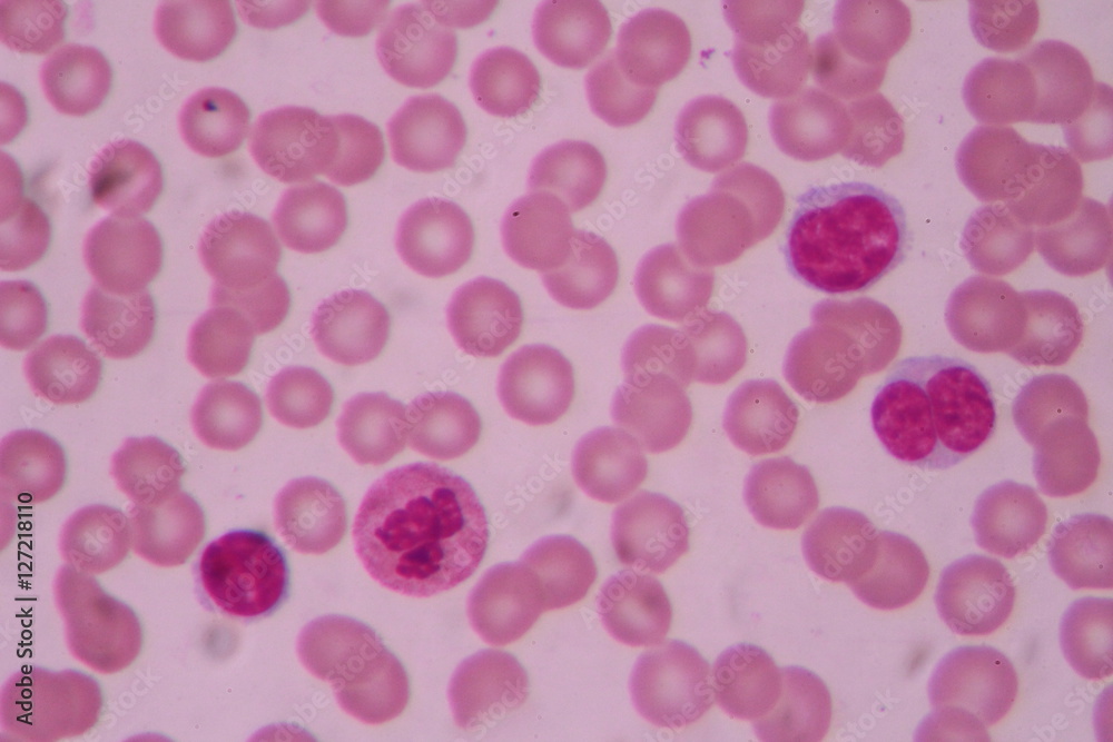 Blood smear shows large number of cancer leukemia cells(Blast cells)