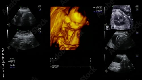 Medical equipment ultrasound scanning. Diagnosis of pregnancy.