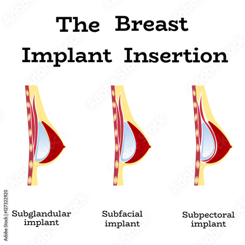 Plastic surgery of silicone breast implant,vector illustration.Female chest anatomy structure - medical wallpaper manual for implantation,implant insertion or breast augmentation surgery