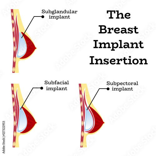 Plastic surgery of silicone breast implant,vector illustration.Female chest anatomy structure - medical wallpaper manual for implantaion,implant insertion or breast augmentation surgery