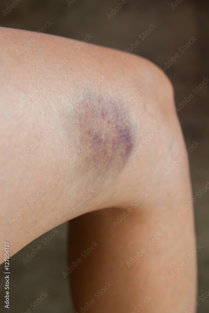 Scratch on the knee caused by a fall.