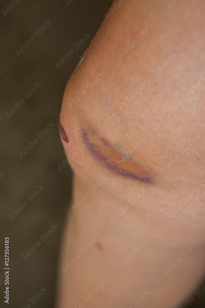 Scratch on the knee caused by a fall. Scratch on the knee caused by a fall.
