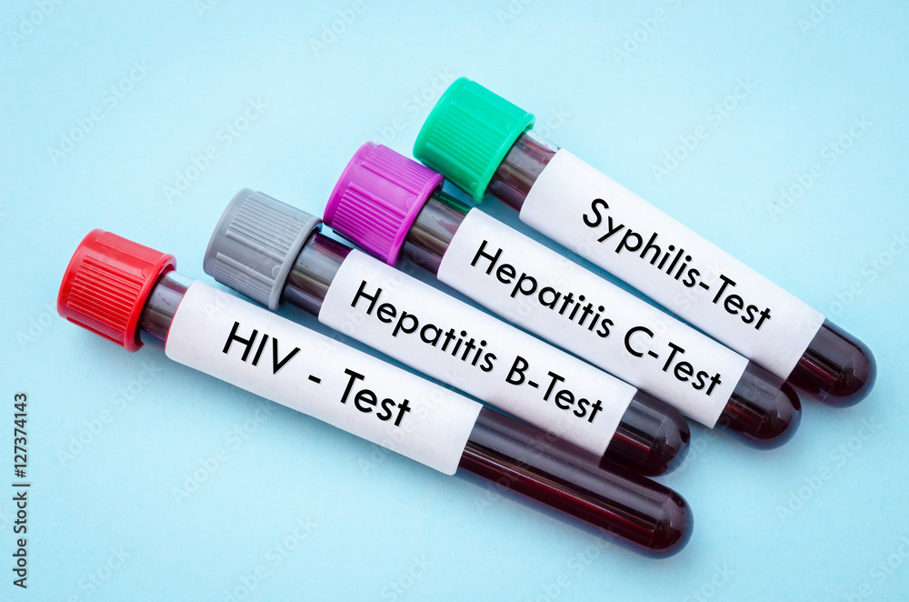 Obraz premium IV, HCV, HBV and shyphilis.