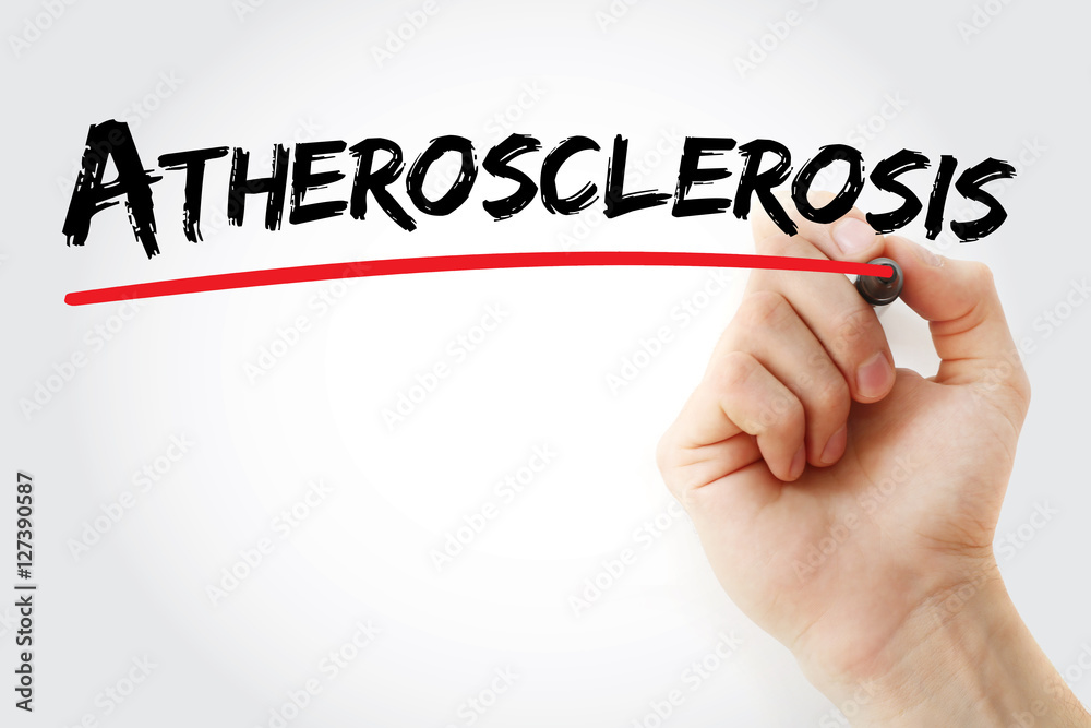 Hand writing Atherosclerosis with marker, concept background Hand writing Atherosclerosis with marker, concept background