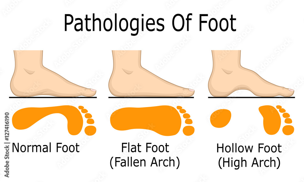 Illustration of foot pathologies, such as flat and hollow foot