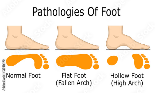 Illustration of foot pathologies, such as flat and hollow foot