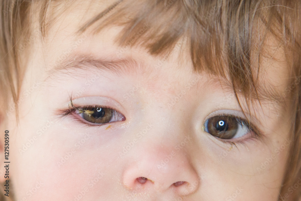 Kleines Kind mit geschwollenem Auge und Bindehautentzündung am rechten Auge  Stock-Foto | Adobe Stock