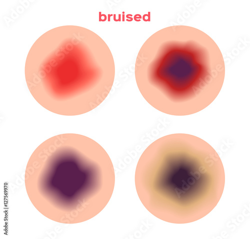 bruised skin from a little bit to serious bruised . It bleeding in side the skin