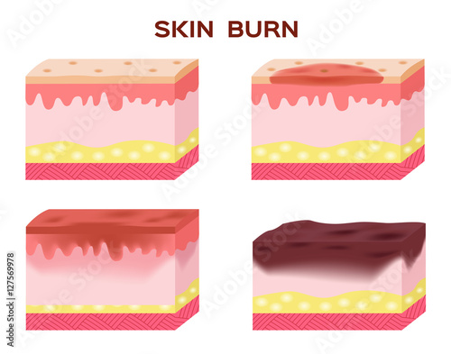 step of skin burn . Normal skin to serious burn skin . vector and icon