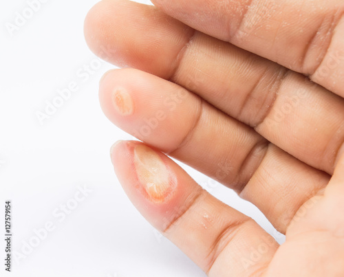 blisters on finger caused by electric shock