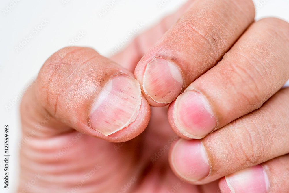 closeup nails having fungus closeup nails having fungus