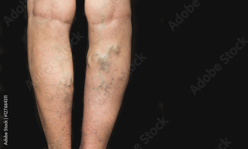 Varicose veins on a female legs