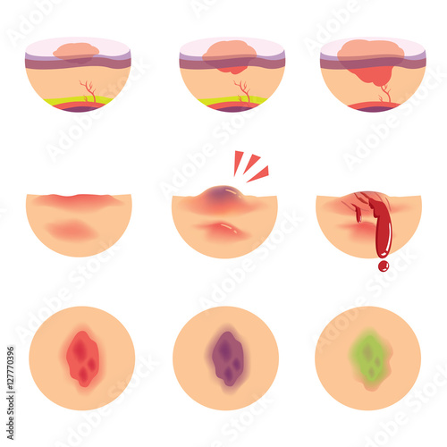 Hematomas skin stages of bruises scenarios. vector  illustration