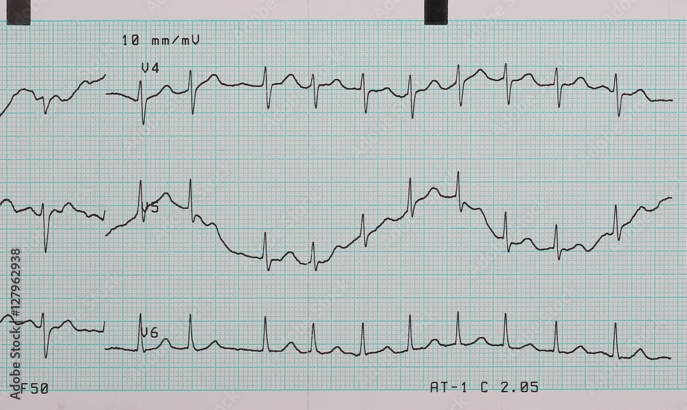 EKG arrhythmia absoluta, printout background