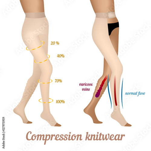 Compression knitwear for varicose veins in the legs. Stockings to improve blood flow.