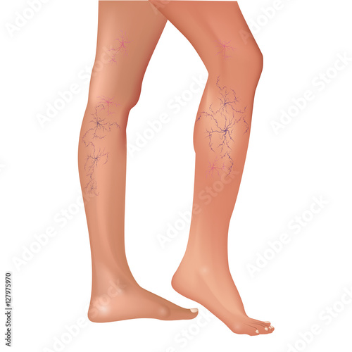 Varicose veins in the legs. Vascular or spider vessels.