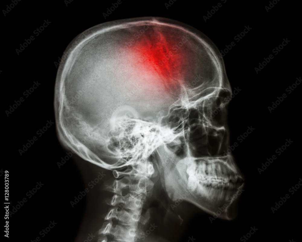 Stroke . film x-ray skull lateral view show human skull and stroke . cerebrovascular accident . isolated background Stroke . film x-ray skull lateral view show human skull and stroke . cerebrovascular accident . isolated background