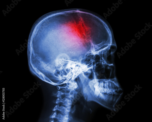 Stroke . film x-ray skull lateral view show human skull and stroke . cerebrovascular accident . isolated background