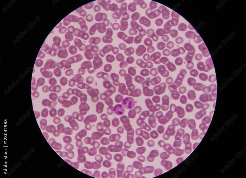 Rouleaux formation in the blood smear and neutrophil. Stock Photo