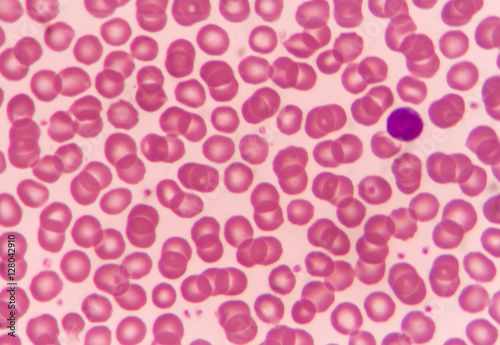 Normal red blood cells
