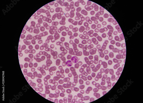 Rouleaux formation in the blood smear and neutrophil.