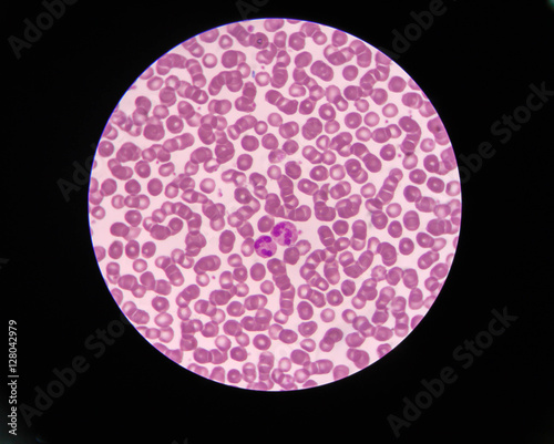 Blood smear shows rouleaux formation and neotrophil