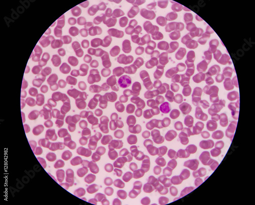 Blood smear shows rouleaux formation and white blood cell