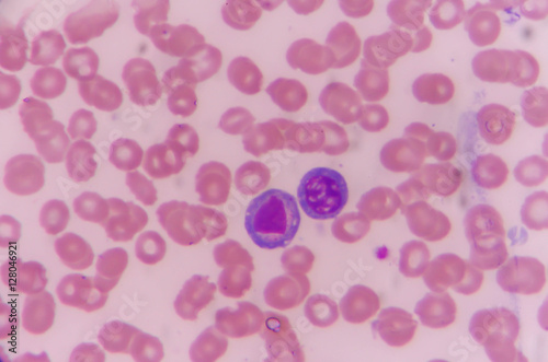 Atypical lymphocyte
