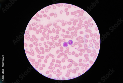 Atypical lymphocyte
