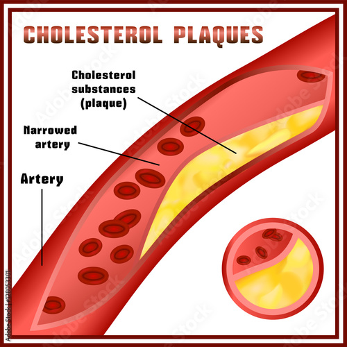 Atherosclerosis. Cholesterol plaques. Disturbance of lipid and protein metabolism, adjournment the cholesterol plaques in arteries.