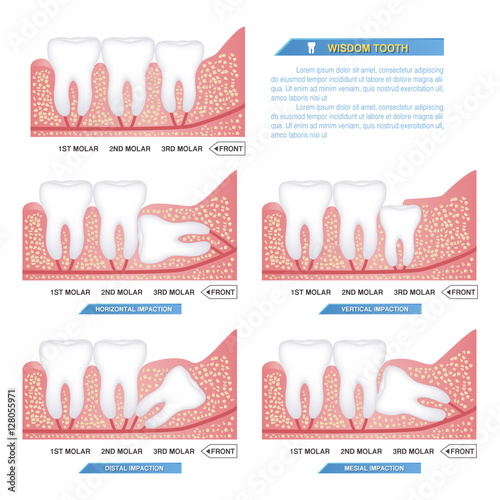 set of impacted wisdom tooth, dental problems, horizontal, mesial, vertical, distal impaction..