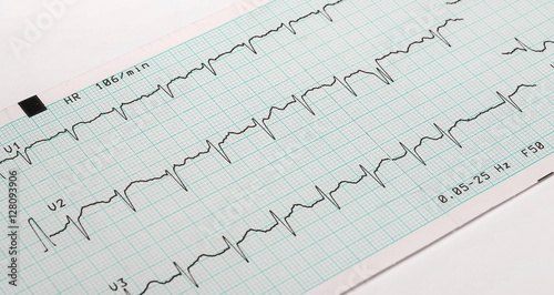 EKG arrhythmia absoluta, printout background photo