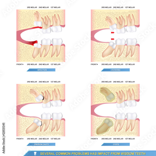 several common problems has impact from wisdom teeth, infection, crowding, erosion cavity and cysts..