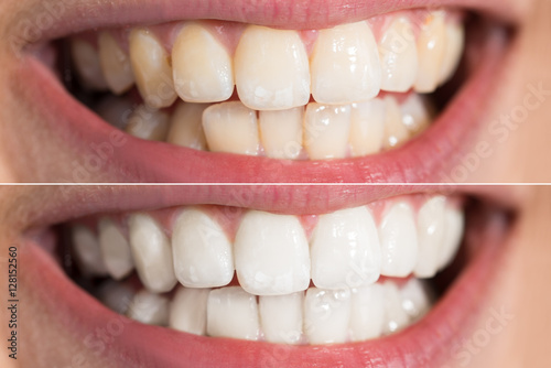 Person Teeth Before And After Whitening photo