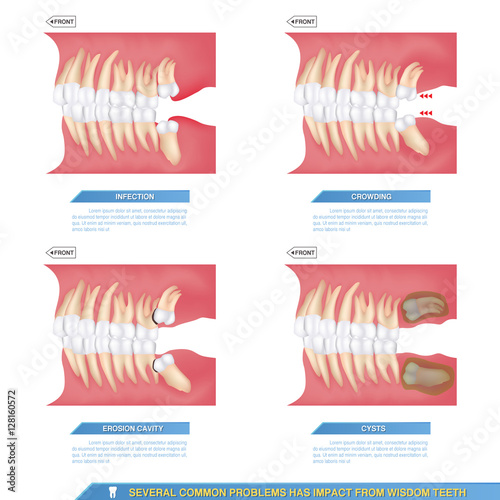 several common problems has impact from wisdom teeth, infection, crowding, erosion cavity and cysts..
