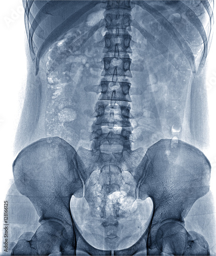 X-Ray Image the spine fornt view Of Human for a medical diagnosis , isolate on white background