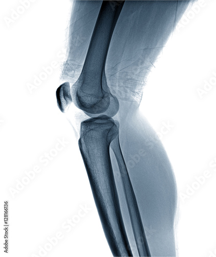 Film x-ray knee AP/lateral : Osteoarthritis knee (Inflammation at knee) , side view , isolate on white background