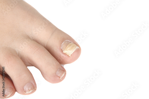 reconstruction nail, nail that went down with a finger - repair