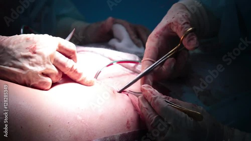 Doctor sews the stomach the patient during the tummy tuck