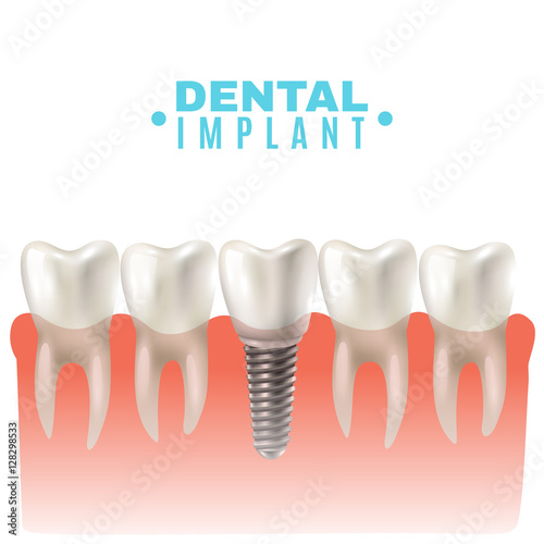 Dental Implant Model Side View Poster 