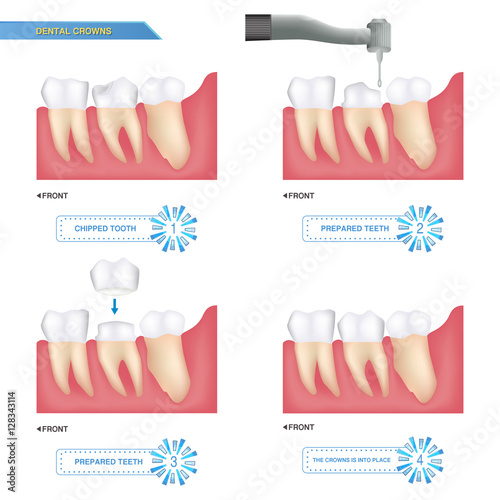 infographics crowns are used to cover a damaged tooth, process of dental crowns
