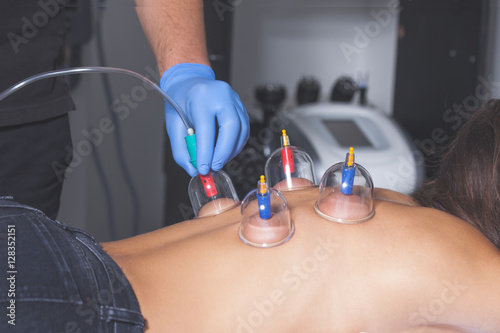 therapist placing vacuum cups on woman back