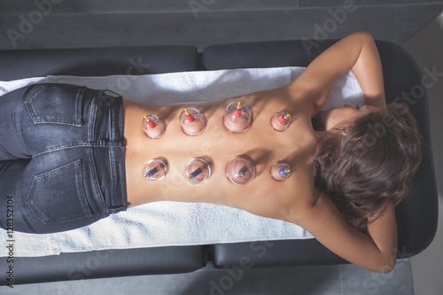 woman on vacuum cupping massage therapy