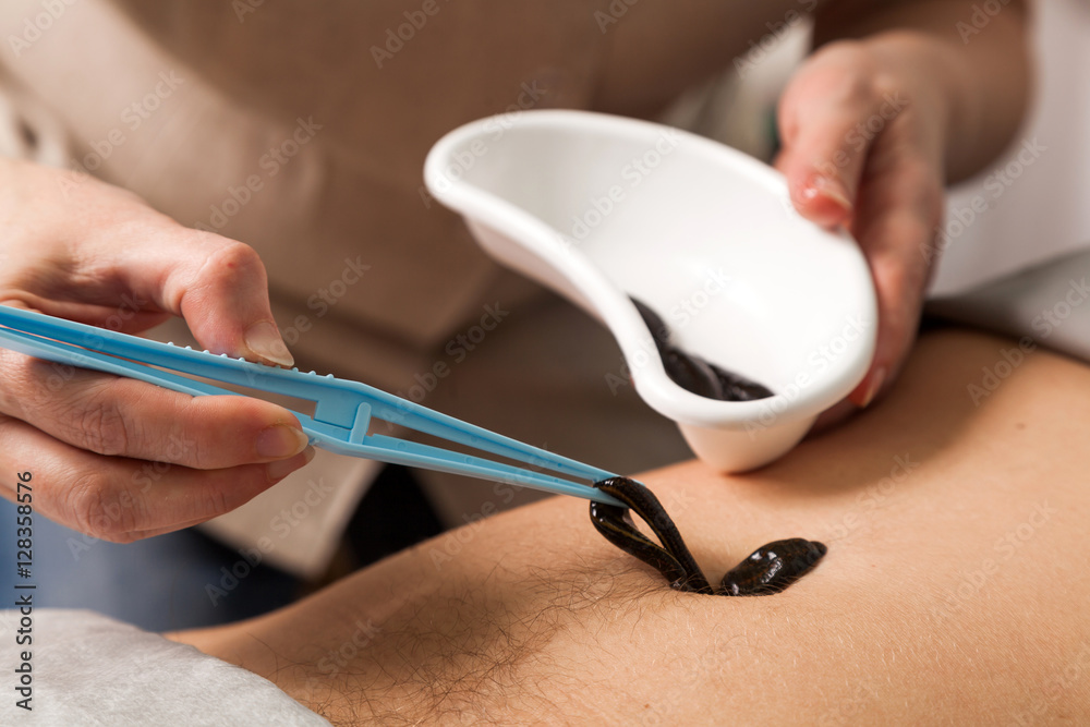 the doctor puts a leech