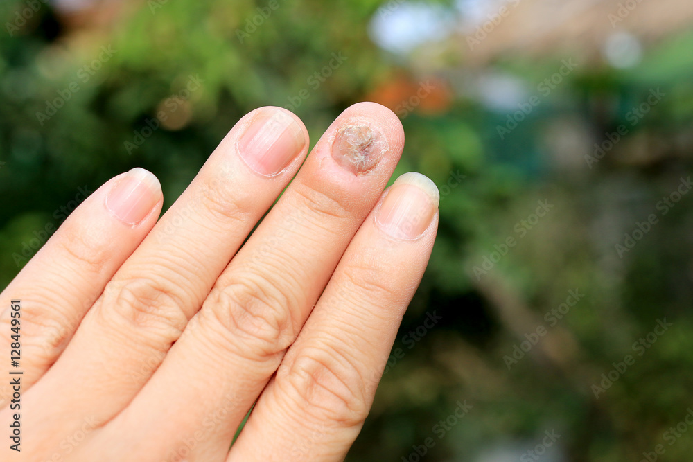 Fungus Infection on Nails Hand, Finger with onychomycosis Stock Photo
