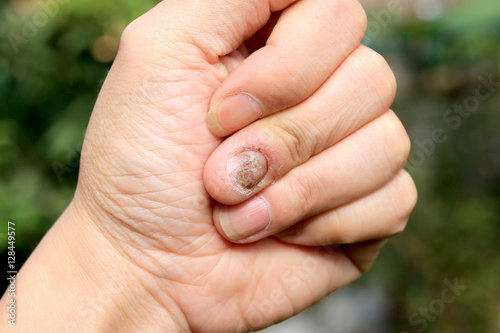 Fungus Infection on Nails Hand, Finger with onychomycosis © narin_nonthamand