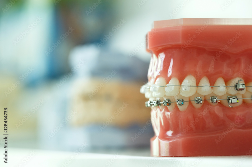 Model of human jaw with wire braces attached