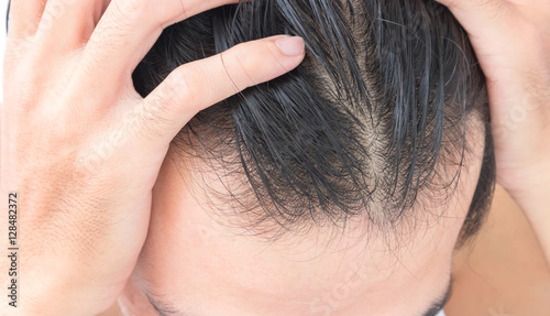 Young man serious hair loss problem for hair loss concept